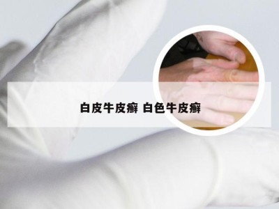 白皮牛皮癣 白色牛皮癣