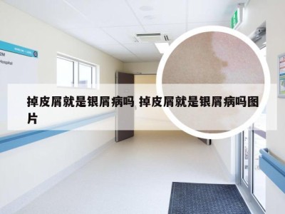 掉皮屑就是银屑病吗 掉皮屑就是银屑病吗图片