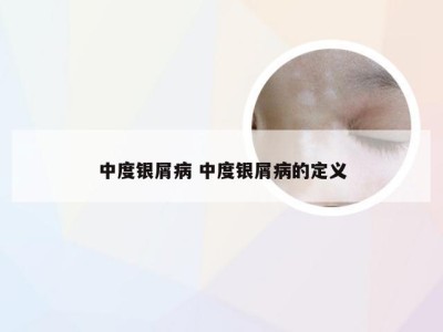 中度银屑病 中度银屑病的定义
