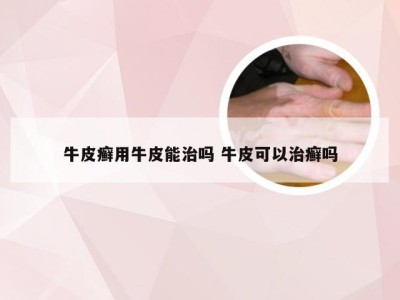 牛皮癣用牛皮能治吗 牛皮可以治癣吗