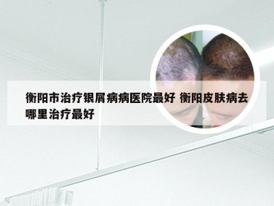 衡阳市治疗银屑病病医院最好 衡阳皮肤病去哪里治疗最好