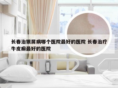 长春治银屑病哪个医院最好的医院 长春治疗牛皮癣最好的医院