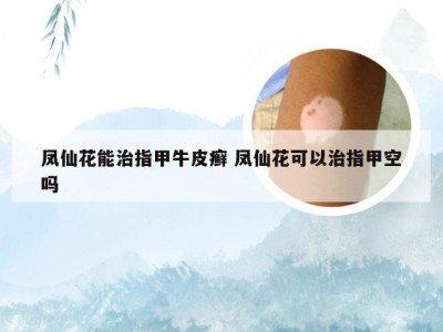 凤仙花能治指甲牛皮癣 凤仙花可以治指甲空吗