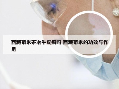 西藏菊米茶冶牛皮癣吗 西藏菊米的功效与作用