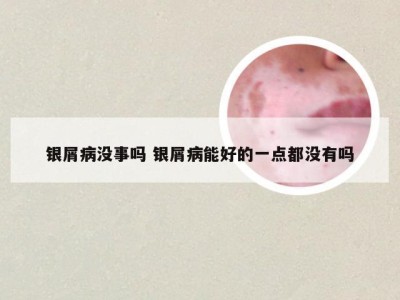 银屑病没事吗 银屑病能好的一点都没有吗