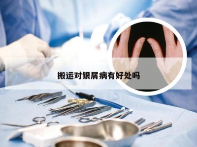 搬运对银屑病有好处吗