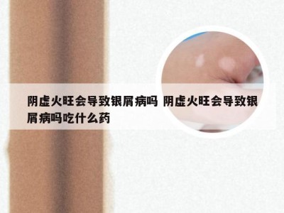 阴虚火旺会导致银屑病吗 阴虚火旺会导致银屑病吗吃什么药