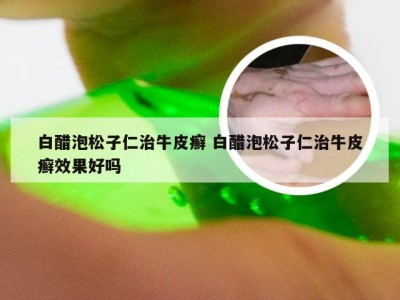 白醋泡松子仁治牛皮癣 白醋泡松子仁治牛皮癣效果好吗