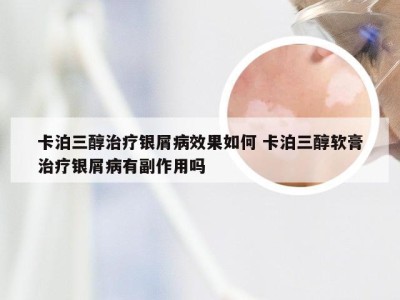 卡泊三醇治疗银屑病效果如何 卡泊三醇软膏治疗银屑病有副作用吗