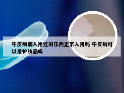 牛皮癣病人用过的东西正常人用吗 牛皮癣可以用护肤品吗
