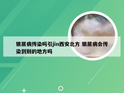 银屑病传染吗引jin西安北方 银屑病会传染到别的地方吗