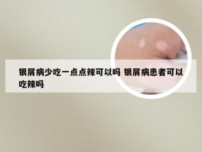 银屑病少吃一点点辣可以吗 银屑病患者可以吃辣吗