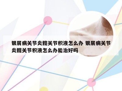 银屑病关节炎髋关节积液怎么办 银屑病关节炎髋关节积液怎么办能治好吗