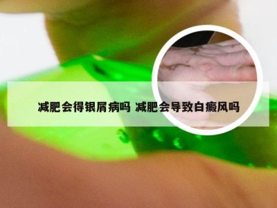 减肥会得银屑病吗 减肥会导致白癜风吗