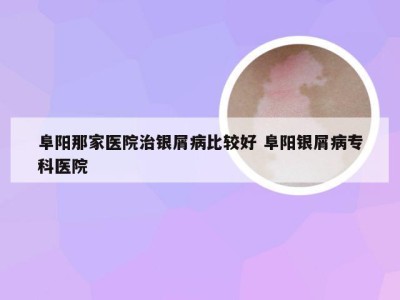 阜阳那家医院治银屑病比较好 阜阳银屑病专科医院
