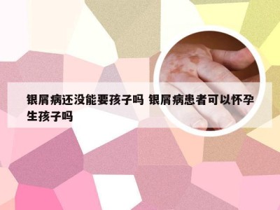 银屑病还没能要孩子吗 银屑病患者可以怀孕生孩子吗