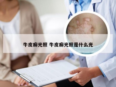 牛皮癣光照 牛皮癣光照是什么光