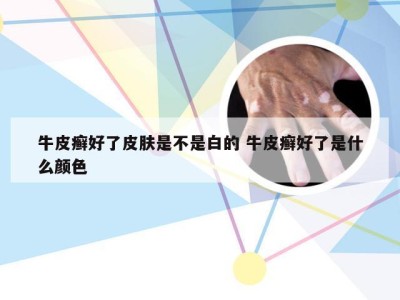 牛皮癣好了皮肤是不是白的 牛皮癣好了是什么颜色