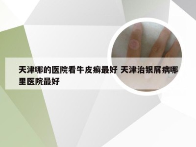 天津哪的医院看牛皮癣最好 天津治银屑病哪里医院最好