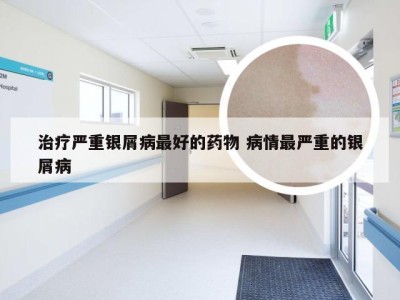 治疗严重银屑病最好的药物 病情最严重的银屑病