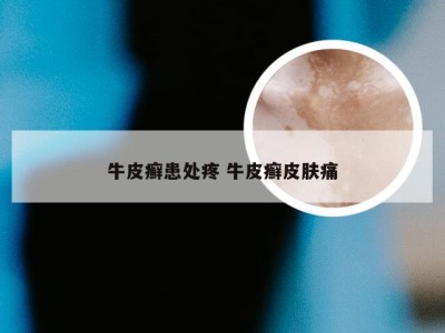 牛皮癣患处疼 牛皮癣皮肤痛