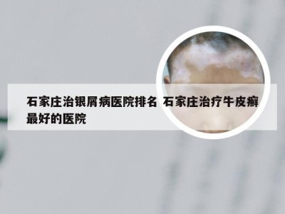 石家庄治银屑病医院排名 石家庄治疗牛皮癣最好的医院