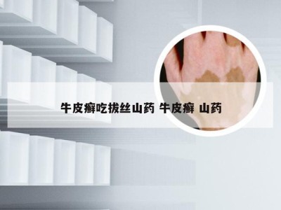 牛皮癣吃拔丝山药 牛皮癣 山药
