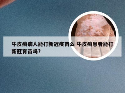 牛皮癣病人能打新冠疫苗么 牛皮癣患者能打新冠育苗吗?
