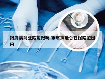银屑病商业险能报吗 银屑病是否在保险范围内