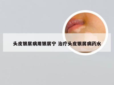 头皮银屑病用银屑宁 治疗头皮银屑病药水