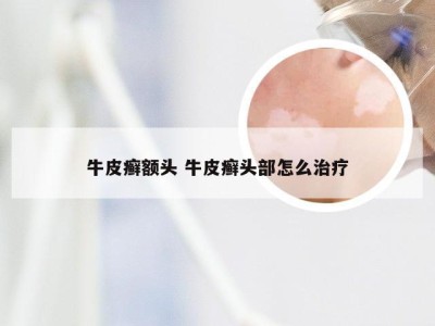牛皮癣额头 牛皮癣头部怎么治疗