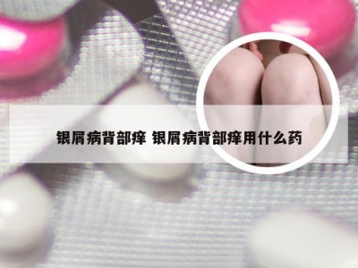 银屑病背部痒 银屑病背部痒用什么药