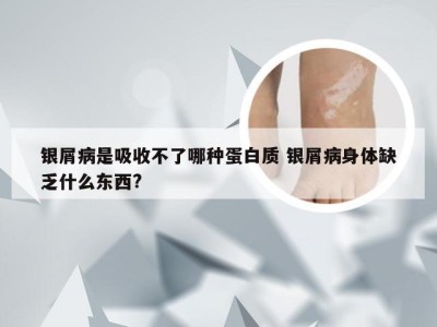 银屑病是吸收不了哪种蛋白质 银屑病身体缺乏什么东西?