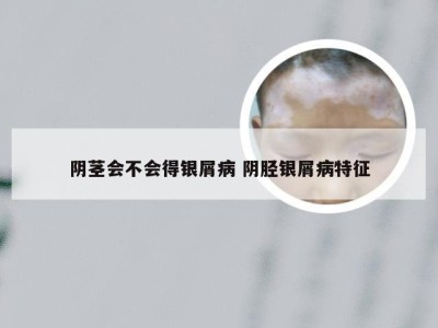 阴茎会不会得银屑病 阴胫银屑病特征