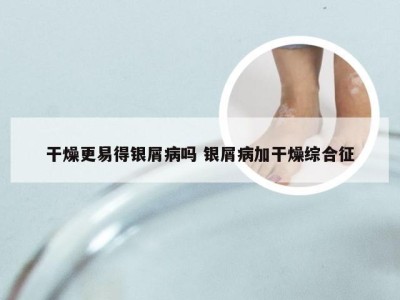 干燥更易得银屑病吗 银屑病加干燥综合征