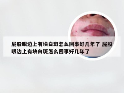 屁股眼边上有块白斑怎么回事好几年了 屁股眼边上有块白斑怎么回事好几年了