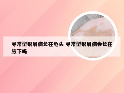 寻常型银屑病长在龟头 寻常型银屑病会长在腋下吗