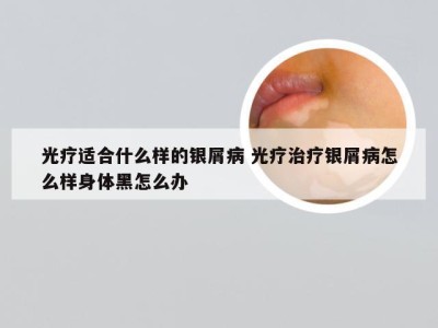 光疗适合什么样的银屑病 光疗治疗银屑病怎么样身体黑怎么办
