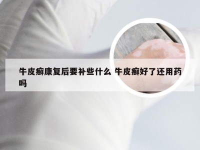 牛皮癣康复后要补些什么 牛皮癣好了还用药吗