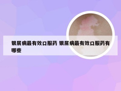 银屑病最有效口服药 银屑病最有效口服药有哪些