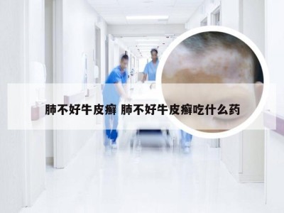 肺不好牛皮癣 肺不好牛皮癣吃什么药
