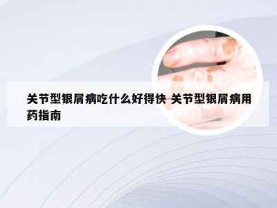 关节型银屑病吃什么好得快 关节型银屑病用药指南