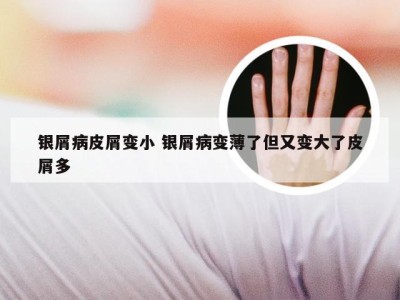 银屑病皮屑变小 银屑病变薄了但又变大了皮屑多