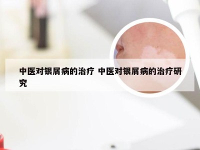 中医对银屑病的治疗 中医对银屑病的治疗研究