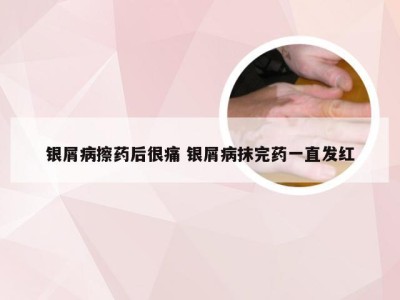 银屑病擦药后很痛 银屑病抹完药一直发红