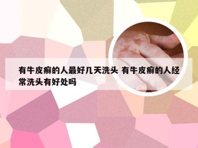 有牛皮癣的人最好几天洗头 有牛皮癣的人经常洗头有好处吗