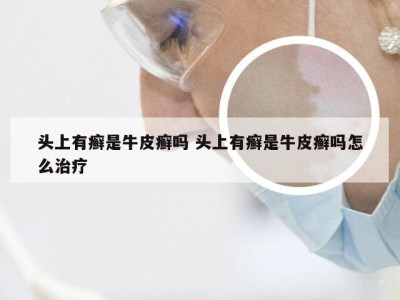 头上有癣是牛皮癣吗 头上有癣是牛皮癣吗怎么治疗