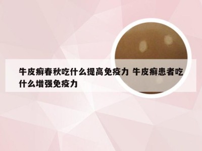 牛皮癣春秋吃什么提高免疫力 牛皮癣患者吃什么增强免疫力