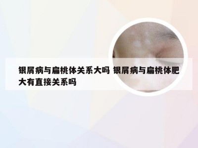 银屑病与扁桃体关系大吗 银屑病与扁桃体肥大有直接关系吗