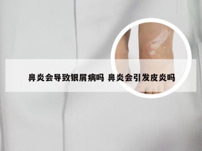 鼻炎会导致银屑病吗 鼻炎会引发皮炎吗
